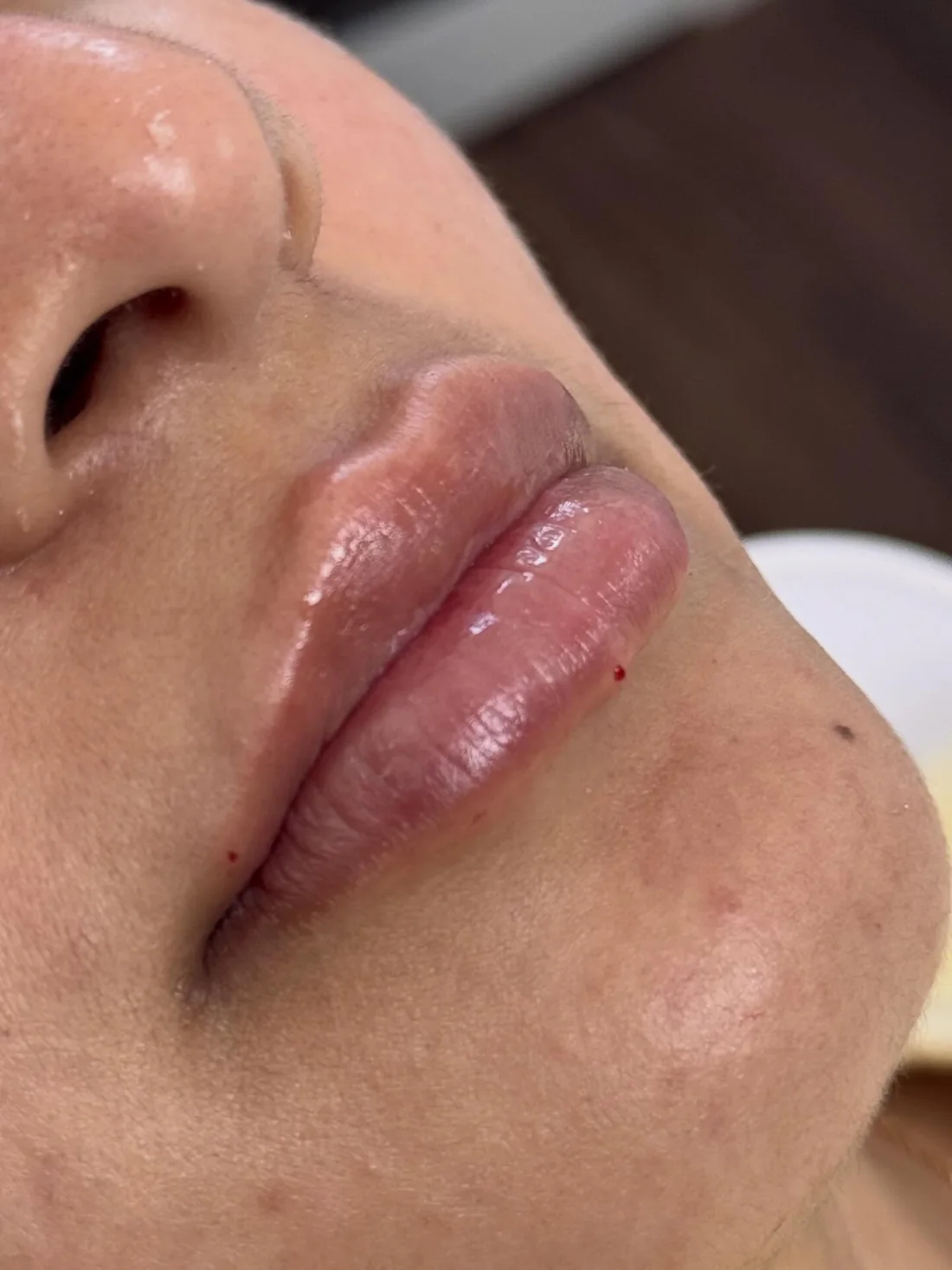 Labios hidratados tras relleno con ácido hialurónico en Dra Piel