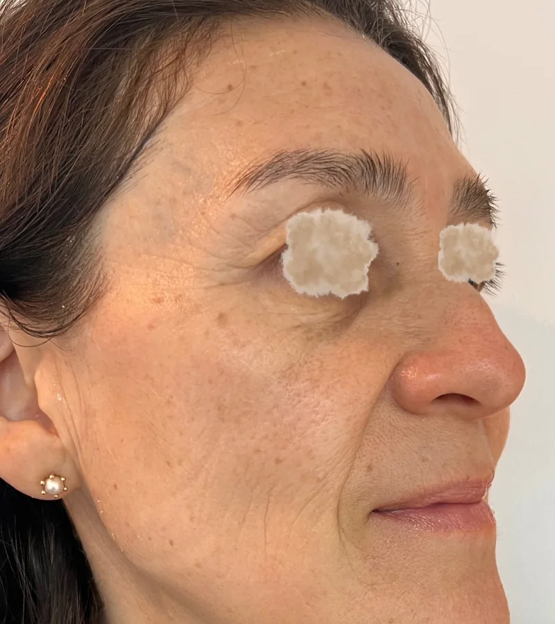Paciente durante un tratamiento de bioestimulación en Dra Piel